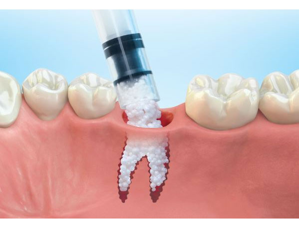 Enxerto ósseo e gengival: como funciona a cirurgia e cuidados antes e