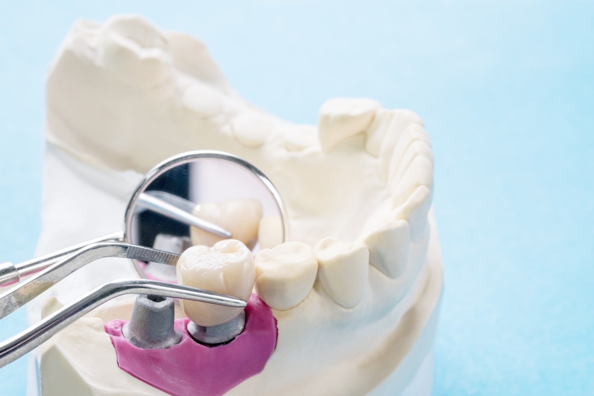 Tipos de implante dentário: veja como escolher o melhor!